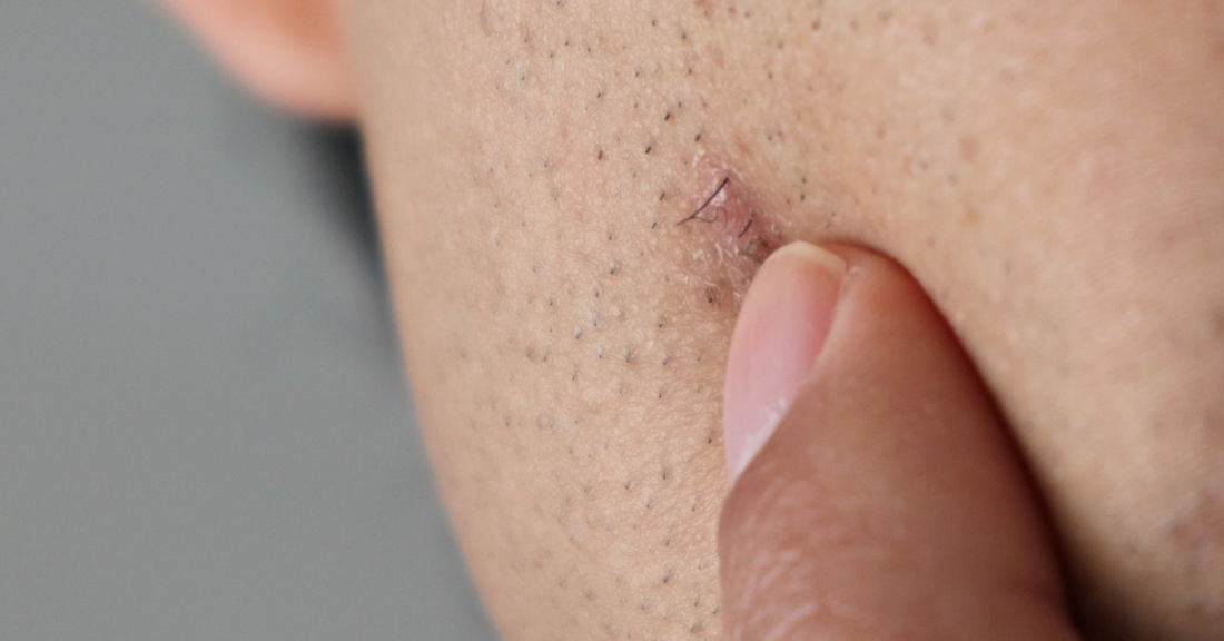 Ingrown Hairs: The Silent Threat in Men’s Grooming