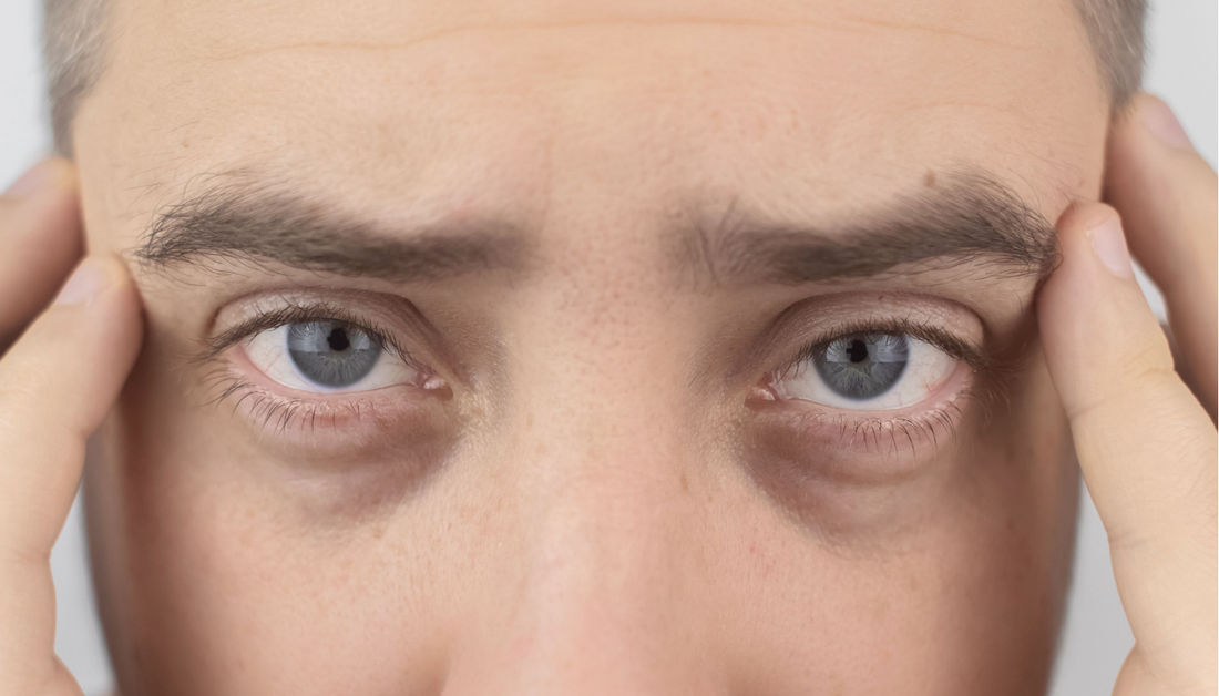 Dark Circles & Eye Bags in Men: What Actually Works