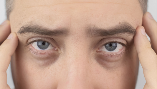 Dark Circles & Eye Bags in Men: What Actually Works